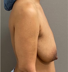 Breast Lift Before Photo by Keshav Magge, MD; Bethesda, MD - Case 49945