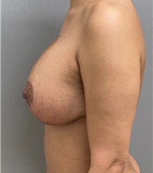 Breast Lift After Photo by Keshav Magge, MD; Bethesda, MD - Case 49945