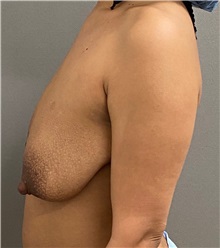 Breast Lift Before Photo by Keshav Magge, MD; Bethesda, MD - Case 49945