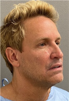Neck Lift Before Photo by Keshav Magge, MD; Bethesda, MD - Case 49960