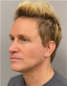 Neck Lift After Photo by Keshav Magge, MD; Bethesda, MD - Case 49960