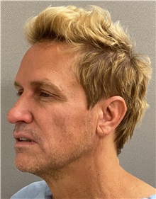 Neck Lift Before Photo by Keshav Magge, MD; Bethesda, MD - Case 49960