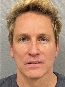 Neck Lift After Photo by Keshav Magge, MD; Bethesda, MD - Case 49960
