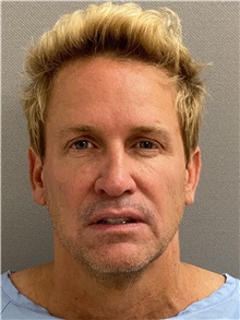 Neck Lift Before Photo by Keshav Magge, MD; Bethesda, MD - Case 49960