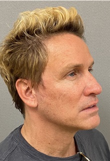 Facelift After Photo by Keshav Magge, MD; Bethesda, MD - Case 49961