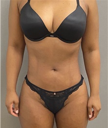 Liposuction After Photo by Keshav Magge, MD; Bethesda, MD - Case 49959