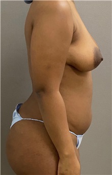 Liposuction Before Photo by Keshav Magge, MD; Bethesda, MD - Case 49959