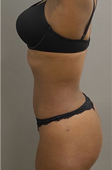 Liposuction After Photo by Keshav Magge, MD; Bethesda, MD - Case 49959