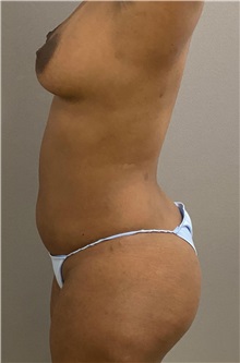 Liposuction Before Photo by Keshav Magge, MD; Bethesda, MD - Case 49959
