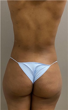 Liposuction Before Photo by Keshav Magge, MD; Bethesda, MD - Case 49959