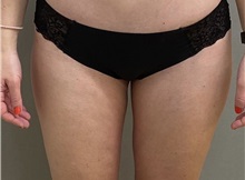 Liposuction After Photo by Keshav Magge, MD; Bethesda, MD - Case 49964