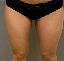 Liposuction After Photo by Keshav Magge, MD; Bethesda, MD - Case 49966