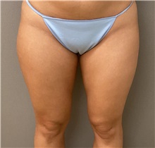 Liposuction Before Photo by Keshav Magge, MD; Bethesda, MD - Case 49966