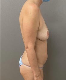 Tummy Tuck Before Photo by Keshav Magge, MD; Bethesda, MD - Case 49963