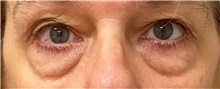 Eyelid Surgery Before Photo by Keshav Magge, MD; Bethesda, MD - Case 49965