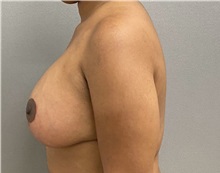 Breast Lift After Photo by Keshav Magge, MD; Bethesda, MD - Case 49967