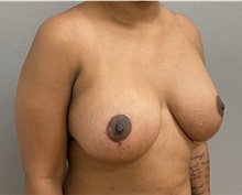 Breast Lift After Photo by Keshav Magge, MD; Bethesda, MD - Case 49967