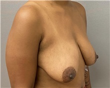 Breast Lift Before Photo by Keshav Magge, MD; Bethesda, MD - Case 49967