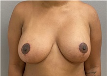 Breast Lift After Photo by Keshav Magge, MD; Bethesda, MD - Case 49967