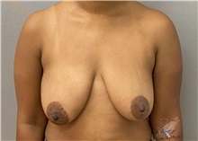 Breast Lift Before Photo by Keshav Magge, MD; Bethesda, MD - Case 49967