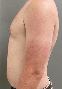 Male Breast Reduction After Photo by Keshav Magge, MD; Bethesda, MD - Case 49969