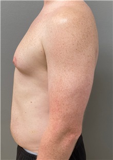 Male Breast Reduction Before Photo by Keshav Magge, MD; Bethesda, MD - Case 49969