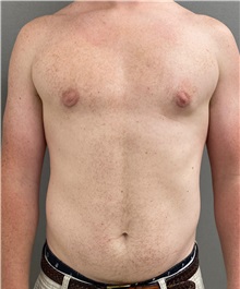 Male Breast Reduction After Photo by Keshav Magge, MD; Bethesda, MD - Case 49969