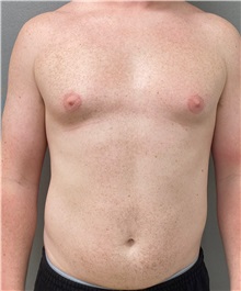 Male Breast Reduction Before Photo by Keshav Magge, MD; Bethesda, MD - Case 49969