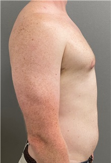 Male Breast Reduction After Photo by Keshav Magge, MD; Bethesda, MD - Case 49969
