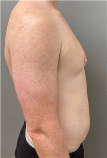 Male Breast Reduction Before Photo by Keshav Magge, MD; Bethesda, MD - Case 49969