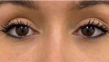 Eyelid Surgery After Photo by Keshav Magge, MD; Bethesda, MD - Case 50012 Eyelid Surgery After Photo by Keshav Magge, MD; Bethesda, MD - Case 50012