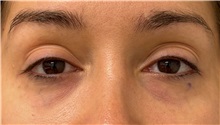 Eyelid Surgery Before Photo by Keshav Magge, MD; Bethesda, MD - Case 50012 Eyelid Surgery Before Photo by Keshav Magge, MD; Bethesda, MD - Case 50012