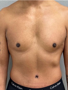 Tummy Tuck After Photo by Keshav Magge, MD; Bethesda, MD - Case 50017 Tummy Tuck After Photo by Keshav Magge, MD; Bethesda, MD - Case 50017