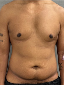 Tummy Tuck Before Photo by Keshav Magge, MD; Bethesda, MD - Case 50017 Tummy Tuck Before Photo by Keshav Magge, MD; Bethesda, MD - Case 50017