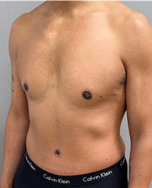 Tummy Tuck After Photo by Keshav Magge, MD; Bethesda, MD - Case 50017