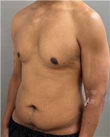 Tummy Tuck Before Photo by Keshav Magge, MD; Bethesda, MD - Case 50017
