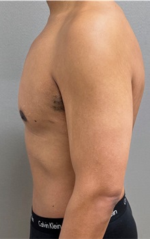 Tummy Tuck After Photo by Keshav Magge, MD; Bethesda, MD - Case 50017