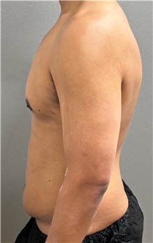 Tummy Tuck Before Photo by Keshav Magge, MD; Bethesda, MD - Case 50017