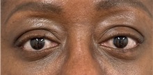 Eyelid Surgery After Photo by Keshav Magge, MD; Bethesda, MD - Case 50018 Eyelid Surgery After Photo by Keshav Magge, MD; Bethesda, MD - Case 50018