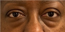 Eyelid Surgery Before Photo by Keshav Magge, MD; Bethesda, MD - Case 50018 Eyelid Surgery Before Photo by Keshav Magge, MD; Bethesda, MD - Case 50018