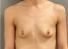 Breast Augmentation Before Photo by Keshav Magge, MD; Bethesda, MD - Case 50055 Breast Augmentation Before Photo by Keshav Magge, MD; Bethesda, MD - Case 50055