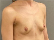 Breast Augmentation Before Photo by Keshav Magge, MD; Bethesda, MD - Case 50055