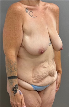 Tummy Tuck Before Photo by Keshav Magge, MD; Bethesda, MD - Case 50058