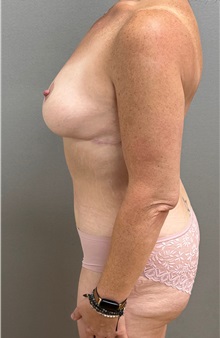 Tummy Tuck After Photo by Keshav Magge, MD; Bethesda, MD - Case 50058