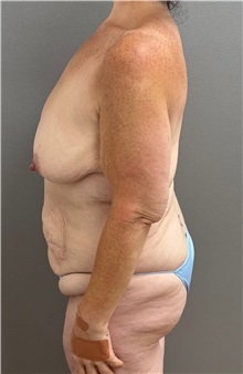Tummy Tuck Before Photo by Keshav Magge, MD; Bethesda, MD - Case 50058