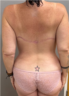 Body Contouring After Photo by Keshav Magge, MD; Bethesda, MD - Case 50056 Body Contouring After Photo by Keshav Magge, MD; Bethesda, MD - Case 50056