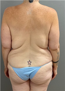 Body Contouring Before Photo by Keshav Magge, MD; Bethesda, MD - Case 50056 Body Contouring Before Photo by Keshav Magge, MD; Bethesda, MD - Case 50056