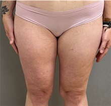 Thigh Lift After Photo by Keshav Magge, MD; Bethesda, MD - Case 50057