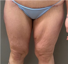 Thigh Lift Before Photo by Keshav Magge, MD; Bethesda, MD - Case 50057