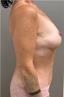 Mommy Makeover After Photo by Keshav Magge, MD; Bethesda, MD - Case 50060